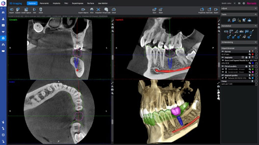 3D radiography