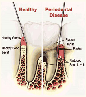 An illustration showing periodontal (gum and bone) disease